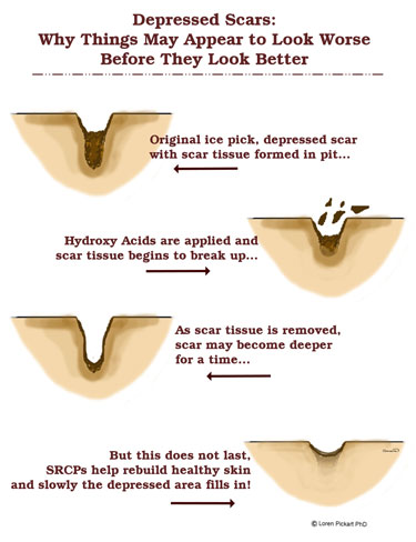 Depressed Scars