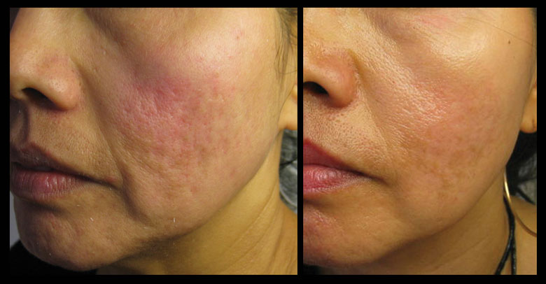 Common Side Effects of Renova Tretinoin Emollient Cream 0