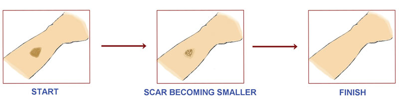Scar Reduction - What Really Works